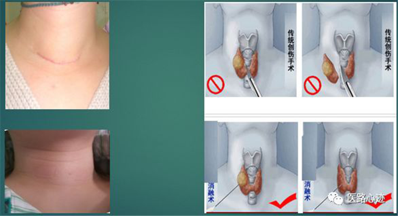 甲状腺结节微波消融术.